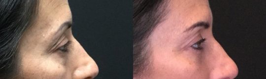 side view of a female patient's eyes before and after Blepharoplasty