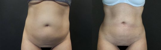Case #110 Liposuction to abdomen and flanks