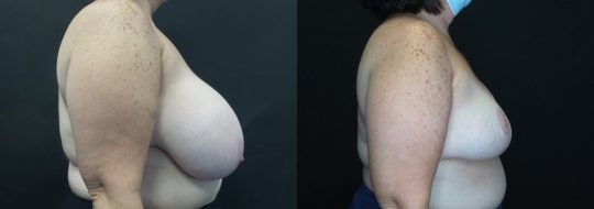 side view of a female patient before and after Breast Reduction