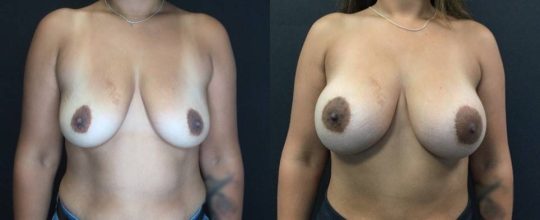 Case #35 Breast Augmentation
