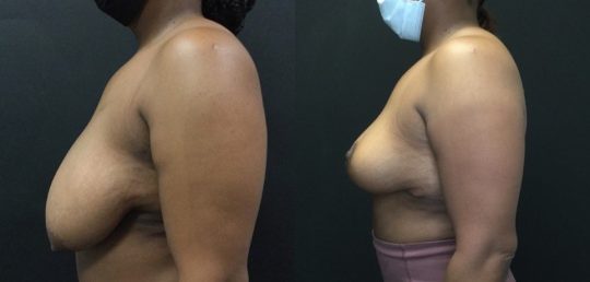 Case #168 Breast Reduction