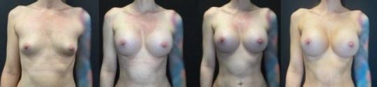 front view of a female patient before and after Breast Augmentation