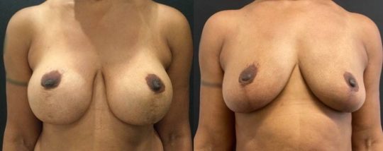 6 months post Implant Removal/Capsulectomy, Breast Lift, Scar Revision, and Fat Grafting to the breasts