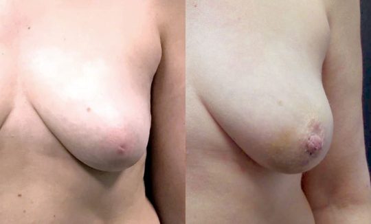 46 yo F 2 wks post inverted nipple repair