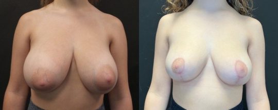 front view of a female patient before and 3 months after breast reduction