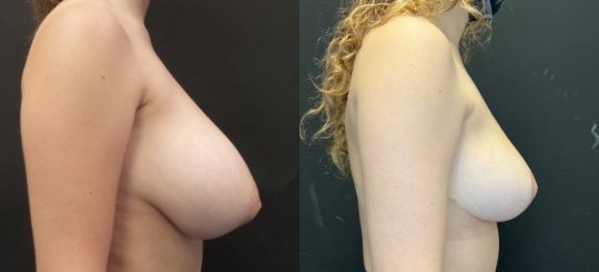 20 year old female 3 months post breast reduction