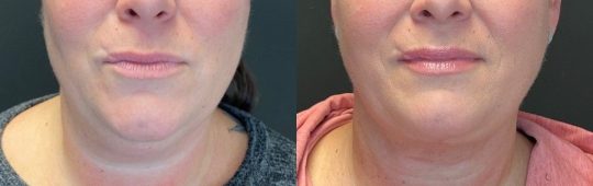 front view of a female patient's lower face before and 1month after submental liposuction