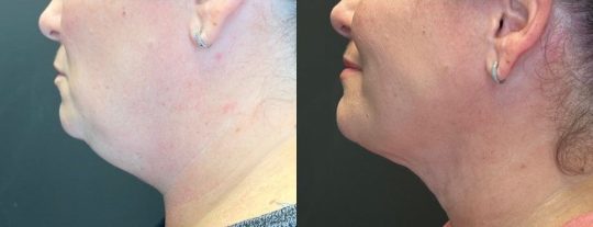 side view of a female patient's lower face before and 1 month after submental liposuction