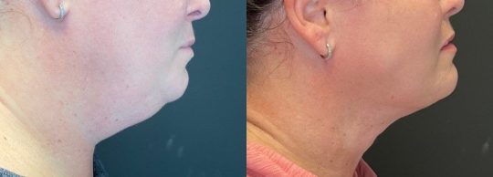 side view of a female patient's lower face before and 1month after submental liposuction