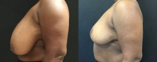 side view of a female patient before and 4 months after breast reduction