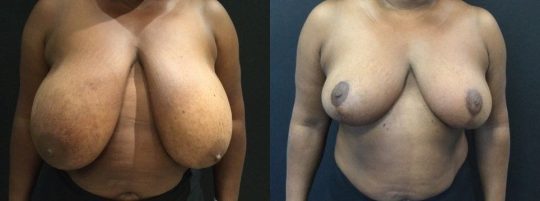 front view of a female patient before and 4 months after breast reduction
