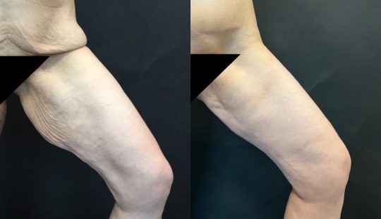 Case #1 9 months post thighplasty