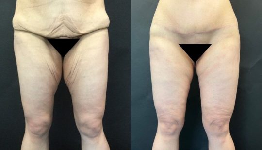 Case #1 9 months post thighplasty
