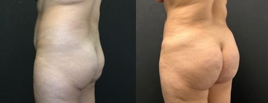 side view of a female patient before and 3 months after BBL Brazilian Butt Lift