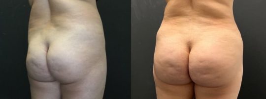 side view of a female patient before and 3 months after BBL Brazilian Butt Lift