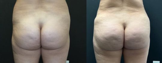 female patient before and 3 months after BBL Brazilian Butt Lift