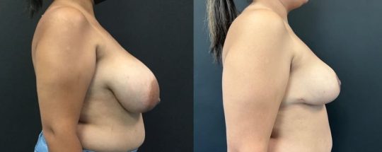 side view of a female patient before and 8 months after breast reduction