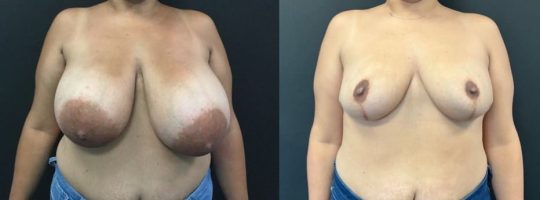 front view of a female patient before and 8 months after breast reduction