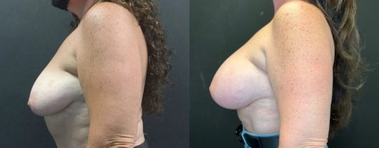 side view of a female patient before and 6 months after breast augmentation