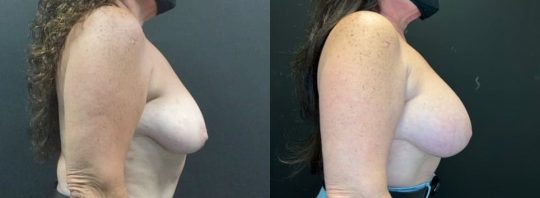 66 years old female patient 6 months post breast augmentation 455 MP+ sientra subglandular