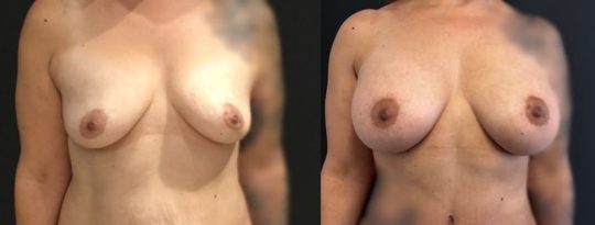 48 years old female patient 6 months post breast augmentation 450 HP mentor submuscular