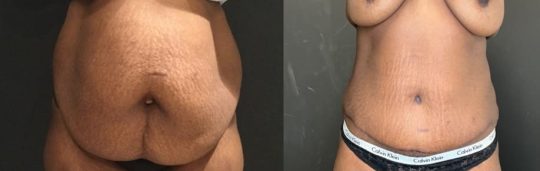 39 years old female patient 8 months post abdominoplasty with hernia repair