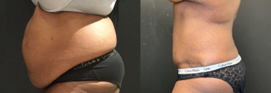 39 years old female patient 8 months post abdominoplasty with hernia repair