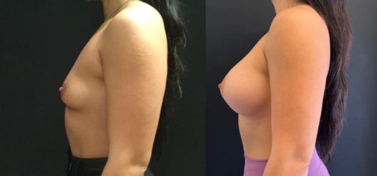 side view of a female patient before and 4 months after breast augmentation