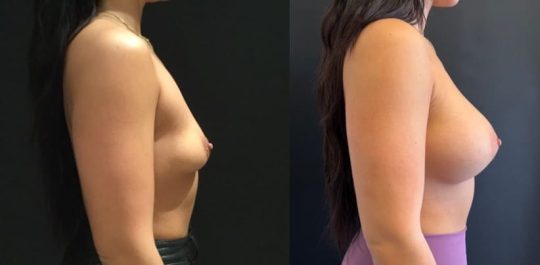 side view of a female patient before and 4 months after breast augmentation