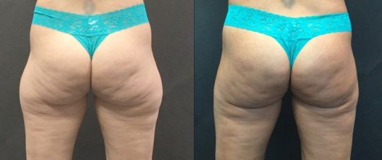 48 years old female patient 2 months post liposuction to saddle bags