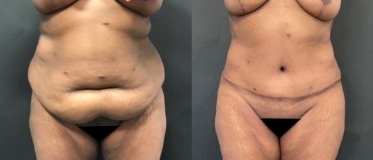 55 years old female patient 3 months post panniculectomy