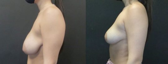 side view of a female patient before and 5 months post breast reduction