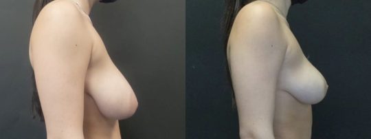 side view of a female patient before and 5 months post breast reduction