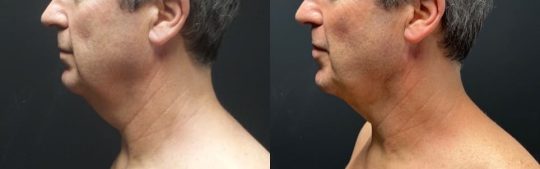 side view of a male patient's lower face before and 1 year after submental lipo with facetite and morpheus
