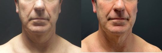 front view of a male patient's lower face before and 1 year after submental lipo with facetite and morpheus