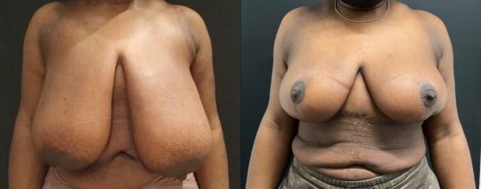 front view of a female patient before and 3 months after breast reduction