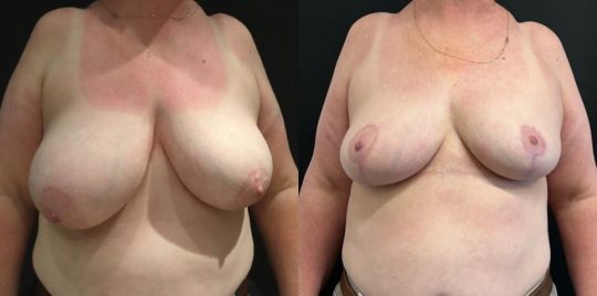 front view of a female patient before and 4 months after breast reduction