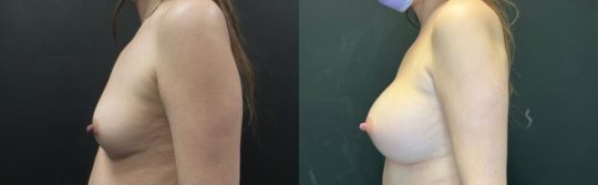 side view of a female patient before and 1 year after breast augmentation