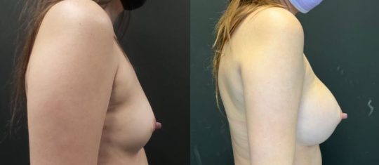 side view of a female patient before and 1 year after breast augmentation