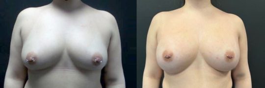 front view of a female patient before and after breast augmentation