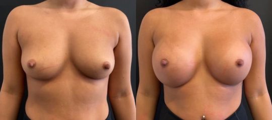 front view of a female patient before and after breast augmentation