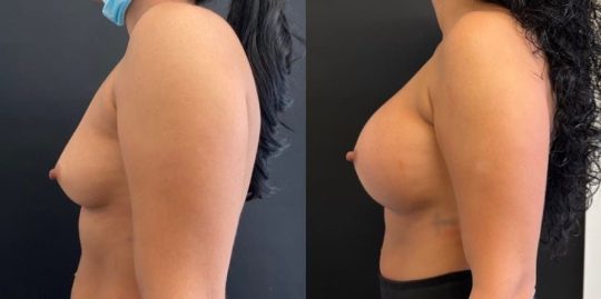 side view of a female patient before and after breast augmentation