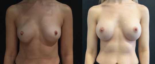 Front view of a female patient before and 1 year after Breast Augmentation procedure