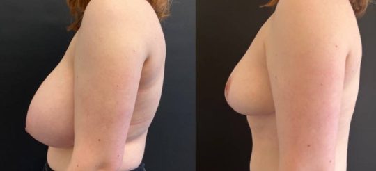 Side view of a female patient before and 3 months after Breast Reduction
