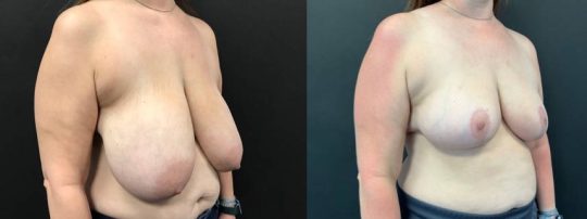 Side view of a female patient before and 3 months after Breast Reduction