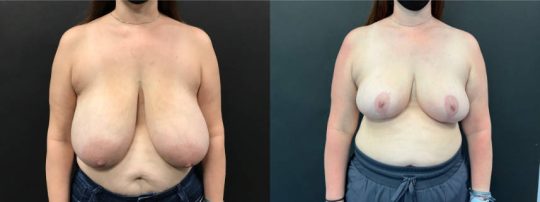 Front view of a female patient before and 3 months after Breast Reduction