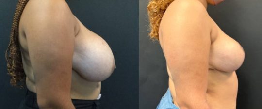 Side view of a female patient before and 6 months after Breast Reduction
