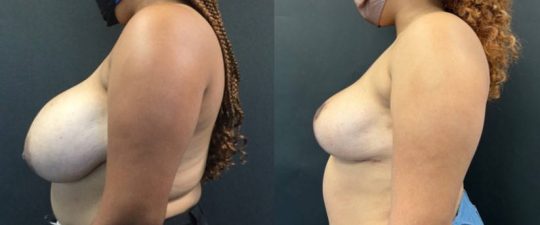 Side view of a female patient before and 6 months after Breast Reduction