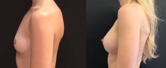 Side view of a female patient before and 1 year after Breast Augmentation procedure