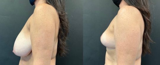 Side view of a female patient before and 1 month after Breast Reduction